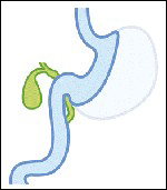 Sleeve gastrectomy